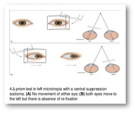 worth 4 dot test|4 base out prism test.